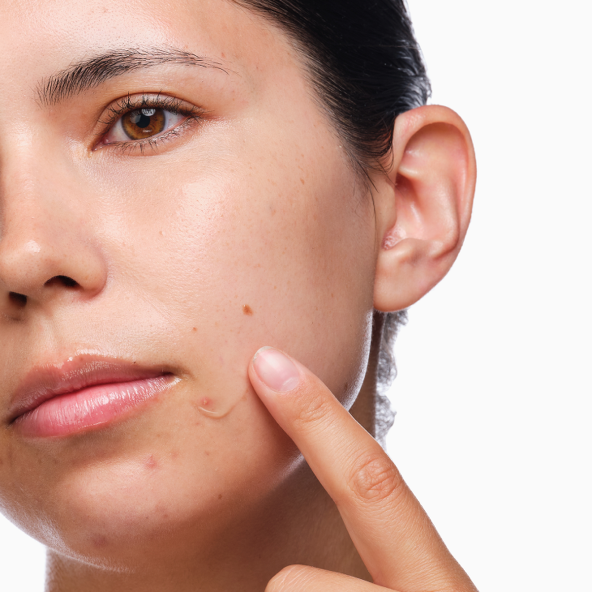 the-acne-set-r8 rdn-the-acne-set-application.png