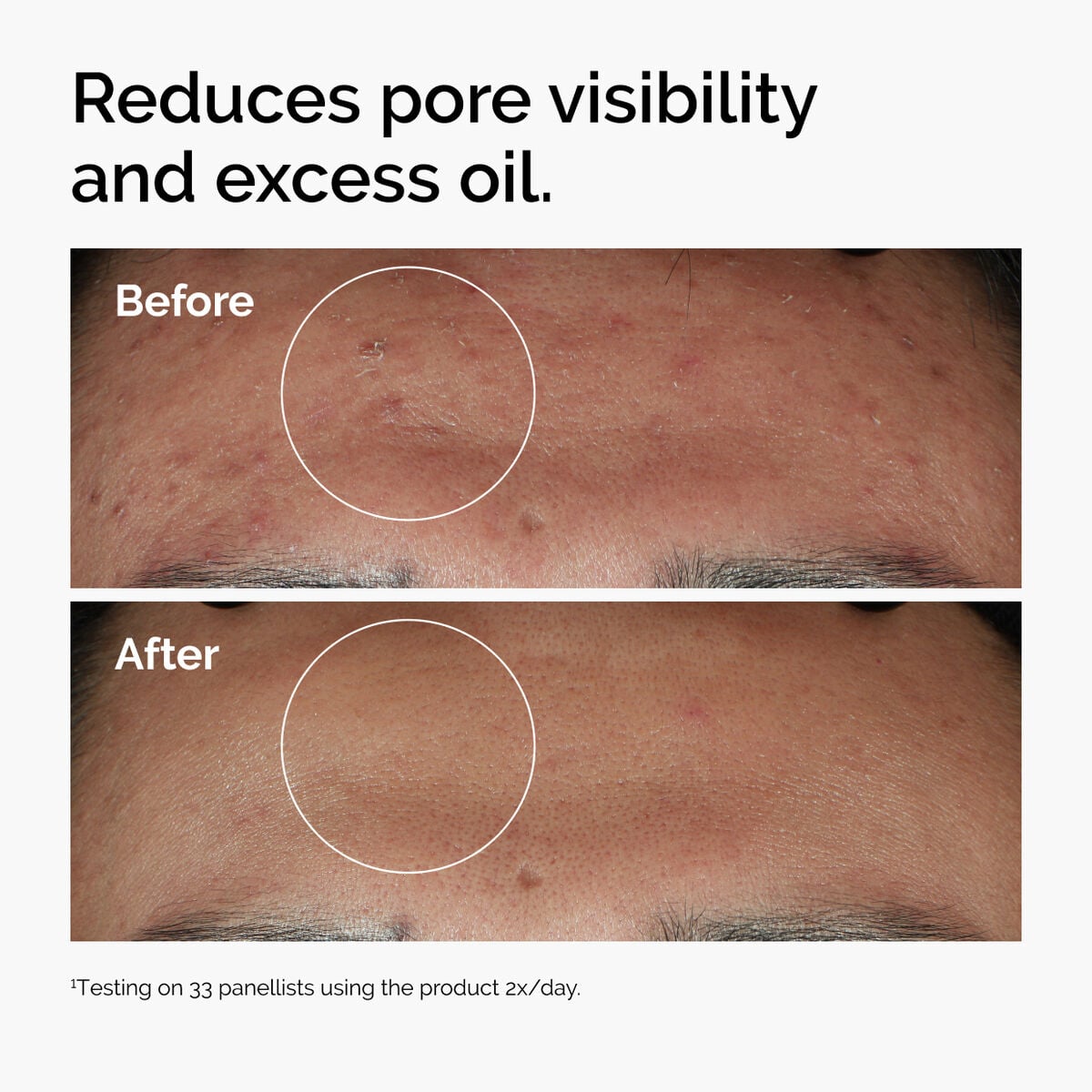 niacinamide-10-zinc-1-b7 ord-niacinamide-zinc-blemish-serum-before-after-pores.jpg