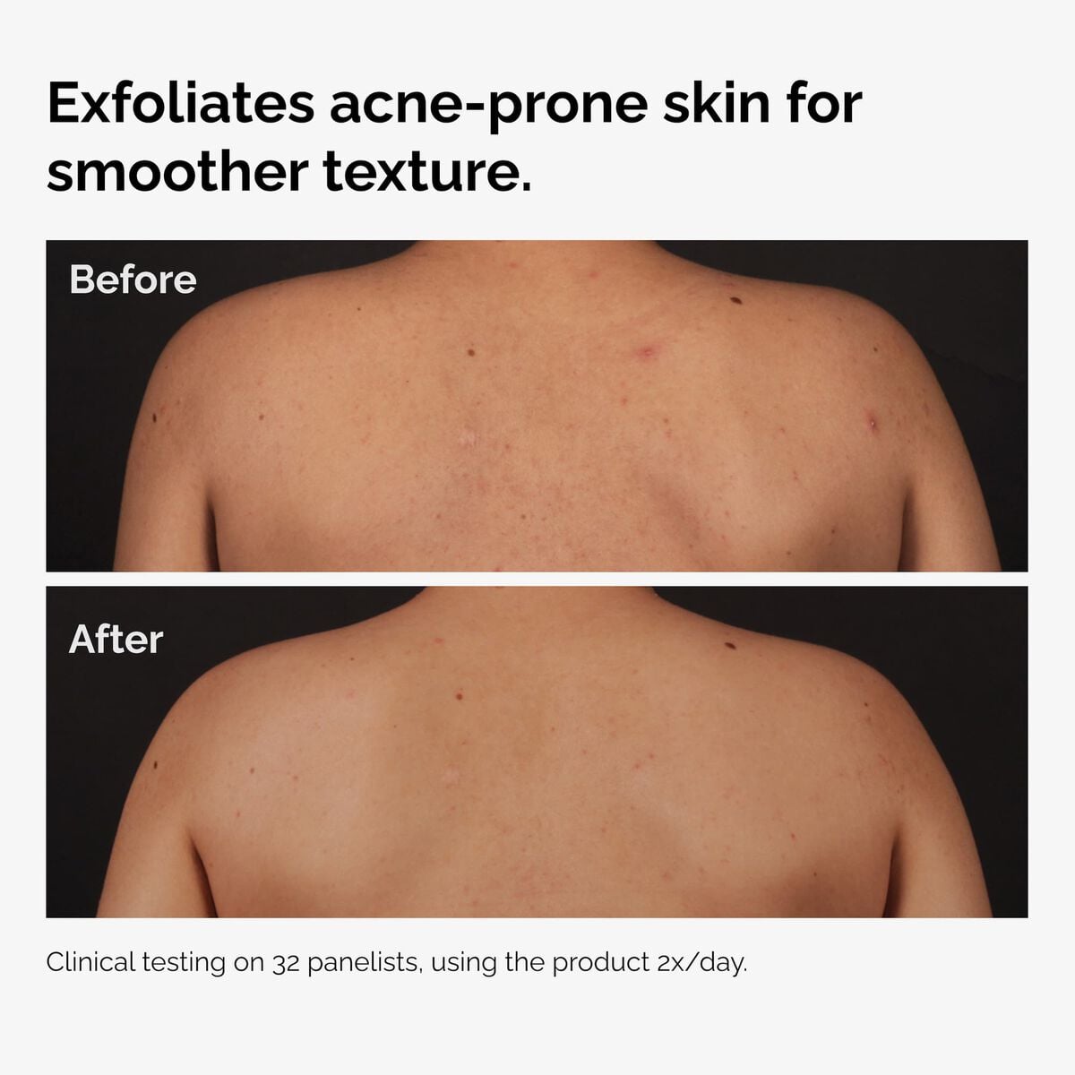 salicylic-acid-0-5-body-serum-o2 ord-salicylic-acid-body-serum-before-after-graphic-NA.jpg